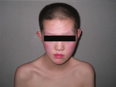 Xxxxy - Xxxy And Xxxxy Syndrome Concept Id C2827598.